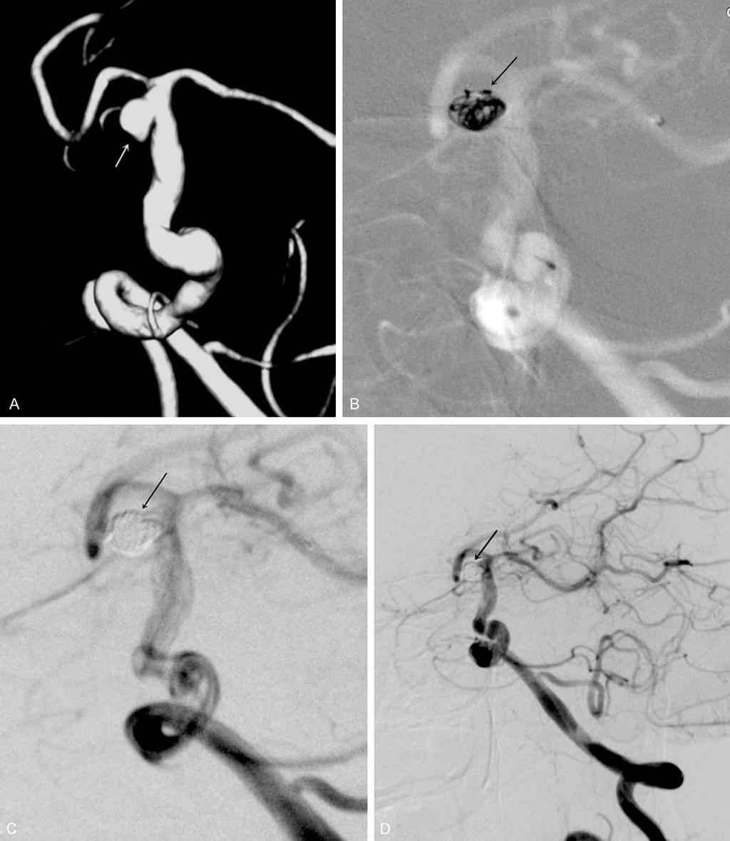 Figure 2. A. The positive side of the left vertebral artery and three-dimensional imaging shows the left superior cerebellar artery aneurysms. B.