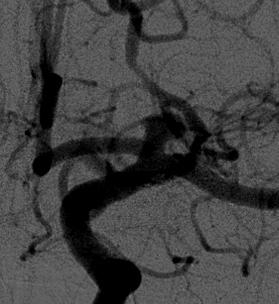 Posterior circulation is worse Aneurysm shape Presence of