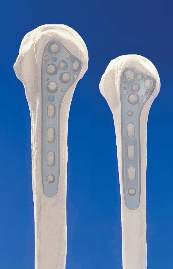 ANATOMY Large Humerus Small Humerus Acumed s goal, when creating the Polarus PHP Proximal Humeral Plate, was to design a plate system that closely replicated the anatomical contours of the proximal