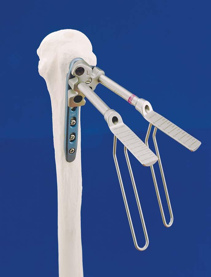 ADVANCED INSTRUMENTATION In addition to the innovative features of the Polarus PHP Proximal Humerus Plate, Acumed designed the instrumentation for ease of use by reducing the