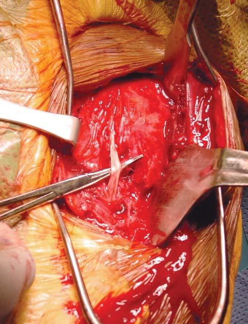 Step 3 Release the fascia along the lateral border of the coracobrachialis and retract it medially to expose the proximal humerus with the subscapularis tendon attachment.