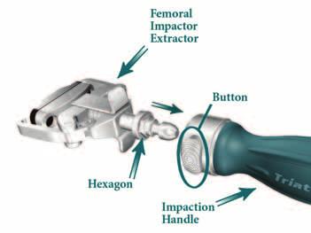 Femoral Impactor Extractor, Impaction Handle and Femoral Trial or Femoral Component Assembly: > Snap the Femoral Impactor Extractor into the