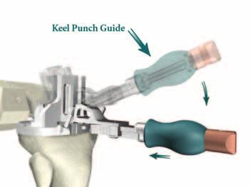 Assembly Instructions > Assemble the Keel Punch Guide to the Universal Tibial Template by inserting the