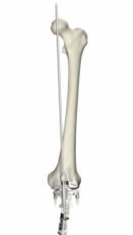 Instrument Bar 6541-1-600 Adjustment Block 6541-1-657 Femoral Alignment Guide Femoral Preparation 6541-1-721 Distal Resection Guide 6541-4-806 Universal Alignment Handle 6541-4-602 Universal