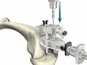 > Once alignment is confirmed, remove the Universal Alignment Handle and the Universal Alignment Rod. > Pin the Distal Resection Guide to the anterior femur using Headless Pins.