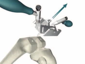 > Remove the 4:1 Cutting Block. > If preparing for a Cruciate Retaining Knee where no PS box preparation is needed, proceed to Femoral Trial Assessment on page 32.