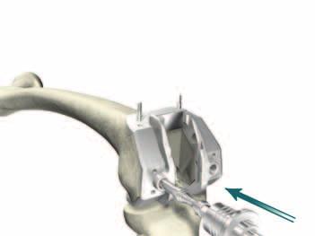 > If Modular Femoral Distal Fixation Pegs are to be used, the location holes may be prepared at this stage using the 1/4" Peg Drill attached to the Universal Driver.