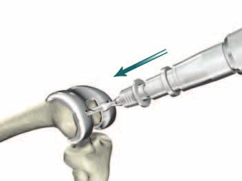 > Remove the Femoral Impactor Extractor and Impaction Handle and assess the fit of the PS or CR Femoral Trial.