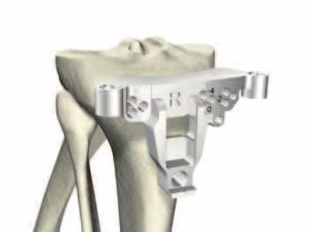 Instrument Bar 6541-4-525 1/4" Peg Drill 6541-4-801 Universal Driver 6541-4-710 Posterior Osteophyte Removal Tool Femoral Preparation Tibial Preparation Figure 37 > There are two options for tibial