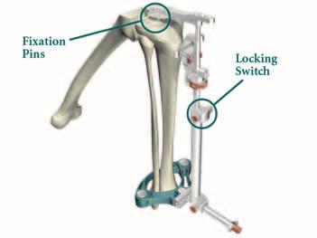 Option 1 Extramedullary Referencing > The tibial resection assembly has five parts: the appropriate Tibial Resection Guide, the Ankle Clamp, the Distal Assembly, the Proximal Rod and the Tibial