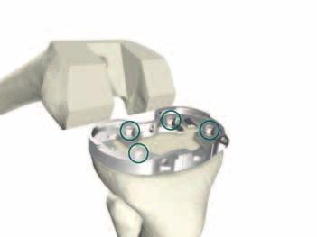 > If additional fixation is required after either Option 1 or 2 is used, place up to four Headed Nails in the holes on the Universal Tibial Template