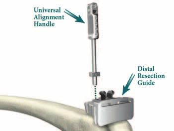 Universal Alignment Handle, Distal Resection Guide and