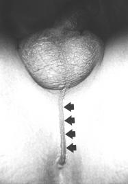 Low imperforate anus in a female with fistula visible at the posterior