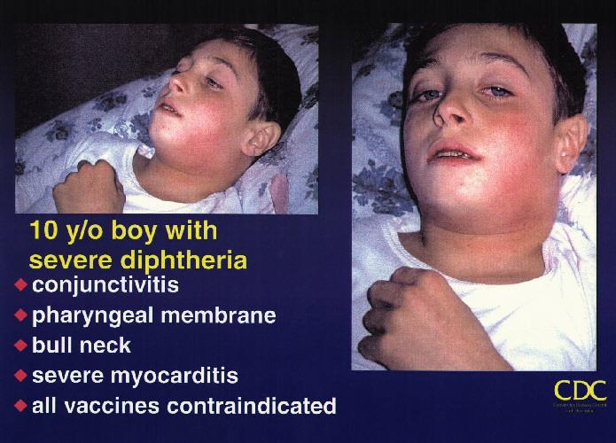 Pharyngeal and Tonsillar Diphtheria Insidious onset Exudate spreads within 2-3 days and may form adherent membrane Membrane may cause