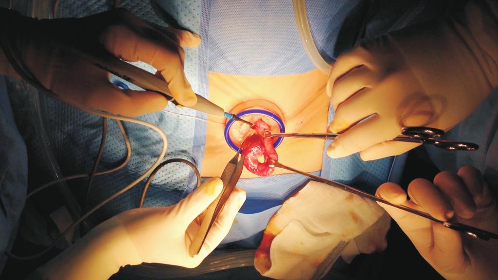 Doo Yeon Go, et al: Transumbilical laparoscopic-assisted appendectomy umbilical incision using a multichannel separable glove port to exteriorize the appendix and perform the appendectomy