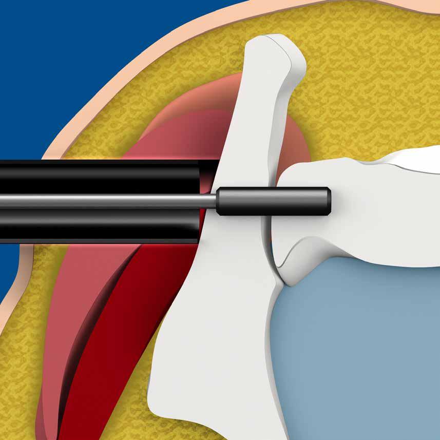 A DIFFERENT APPROACH TO SI JOINT FUSION. TABLE OF CONTENTS GLUTEUS MEDIUS Most SI fusion devices today are assisted by muscle/tissue retractors due to the transgluteal/lateral approach.