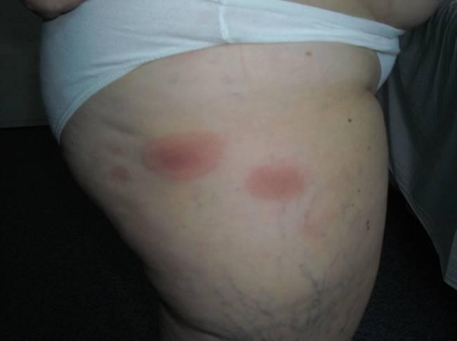 Erythemato-violaceous lesions, slightly infiltrated, edema, round-oval shape, diameter and location range Fig. 3.