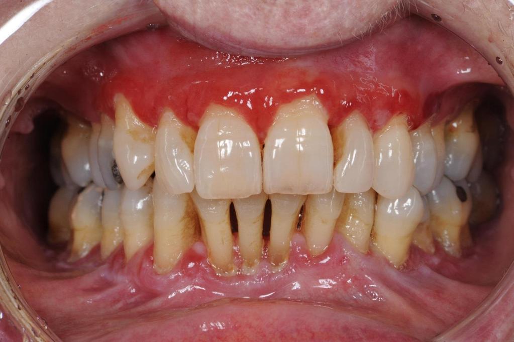 Severe Periodontitis 11% of adults 39% of adults with high