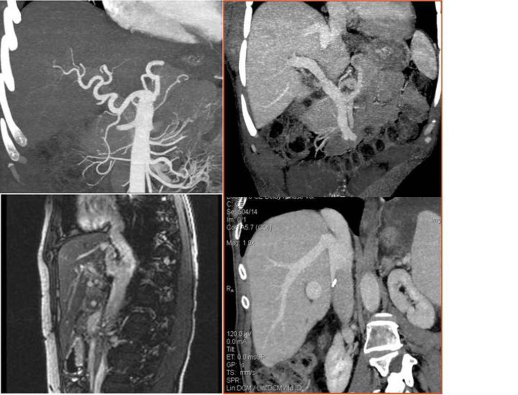 Fig. 1: In the patient with a transplanted pancreas and kidney, the contrast enhanced CT revealed no deviations: retroperitoneal on the right hand side - the transplanted pancreas, on the left - a