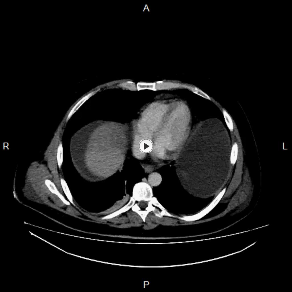 Fig. 8: Thrombosis of the middle and the left hepatic veins in the transplanted liver resulted in the decreased intrahepatic