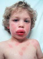 Moderate or Severe Anaphylaxis Swollen lips and face;