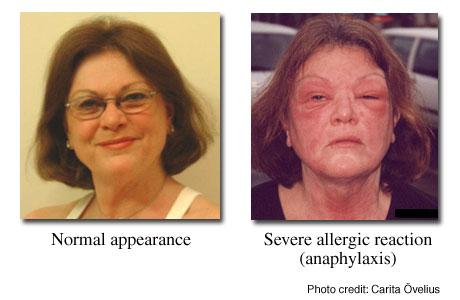 Moderate or Severe Anaphylaxis health.