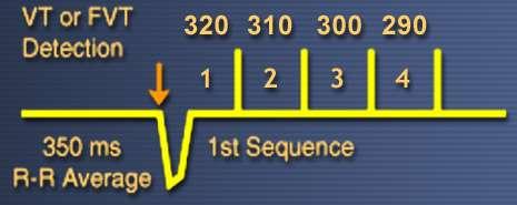 decrement per sequence Ramp A series of pacing pulses