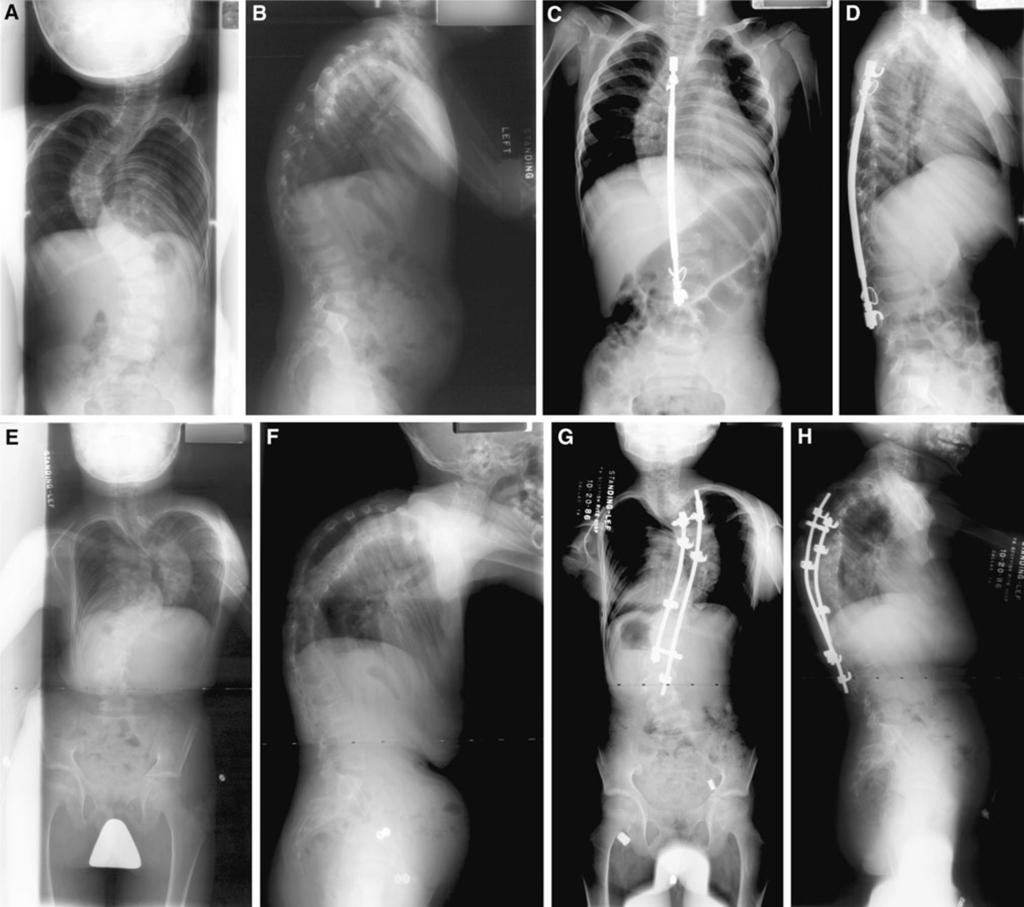 134 J Child Orthop (2012) 6:131 136 Fig. 1 Preoperative anteroposterior (AP) (a) and lateral (b) radiographs of patient 3.