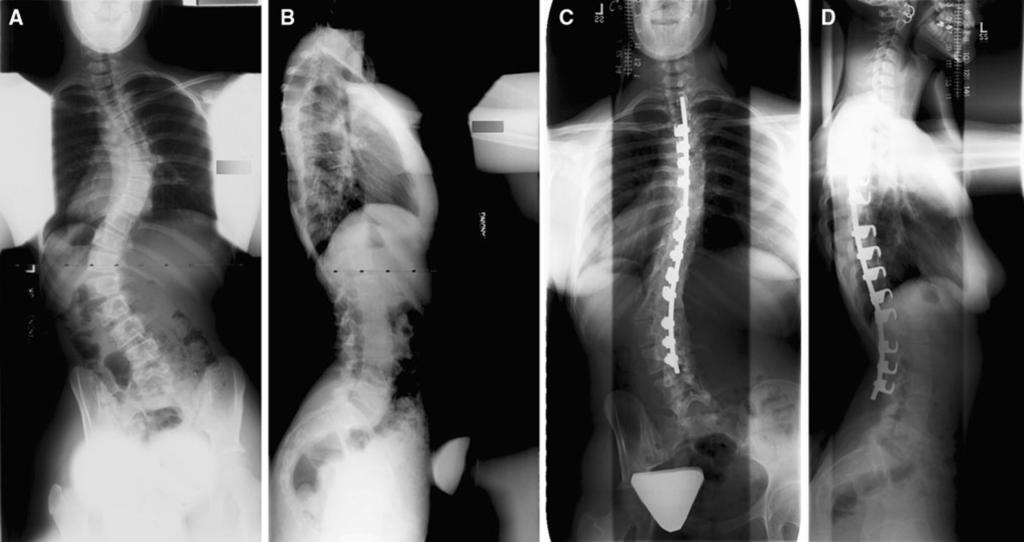 J Child Orthop (2012) 6:131 136 135 Fig. 2 Preoperative AP (a) and lateral (b) radiographs of patient 5.