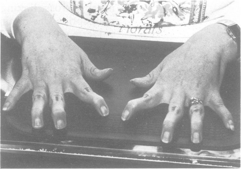 308 Carr, Chiodo, Hilton, Chow, Hockey, Cole dv Figure 3 Appearance of the skin on the dorsum of the proband's hands showing hyperelasticity.