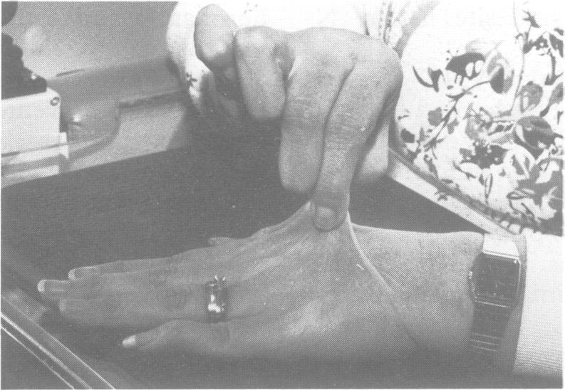 Figure 4 Appearance of the proband's fingers showing Figure 6 Appearance of the proband's feet showing marked laxity of the interphalangeal joints which could plano-abducto-valgus deformities.
