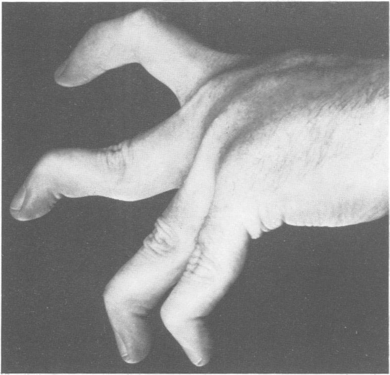 The clinical features of Ehlers-Danlos syndrome type VIIB Figure 8 Appearance of the fingers of the proband's brother showing swan neck deformities.