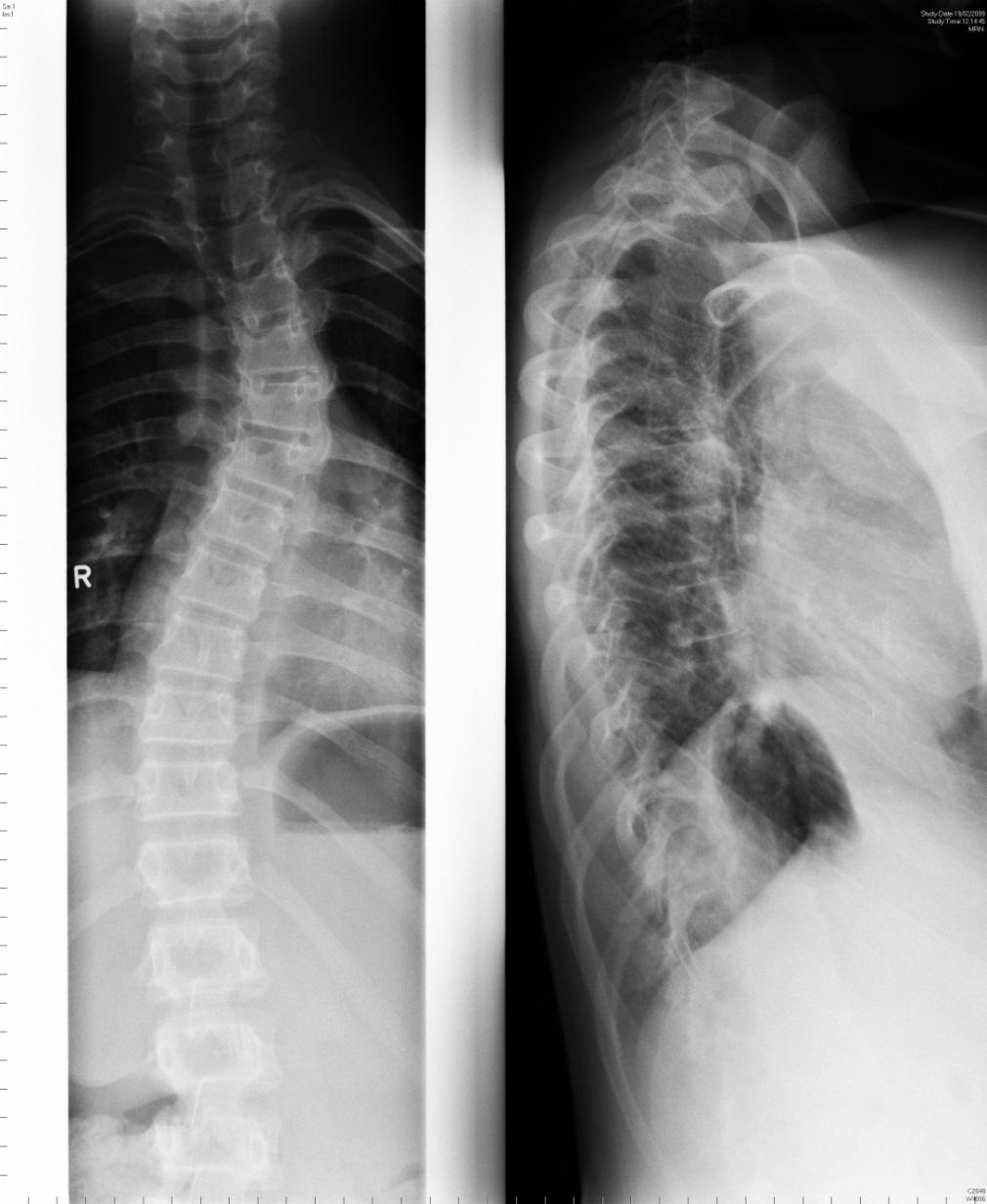 (kypho)scoliosis Broad and flat
