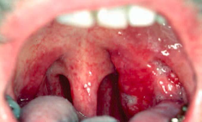 Clinical Manifestations of Oral