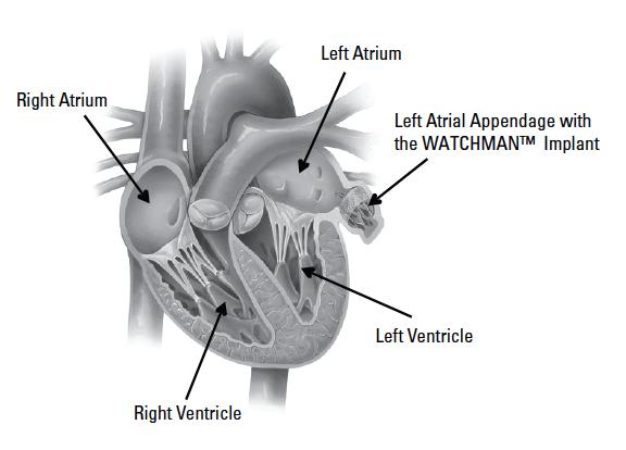 Patient Information Guide Kadlec Regional Medical Center Cardiac Electrophysiology WATCHMAN Left Atrial Appendage Closure Device Your doctor has recommended that you consider undergoing a procedure