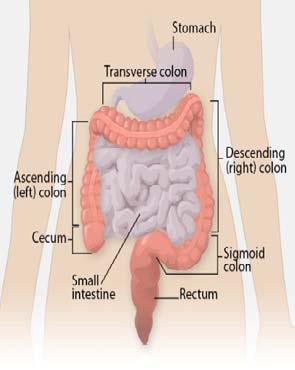 Colorectal Cancer (CRC) Globally more than 1 million people get colorectal cancer every year (In 2012, 1.4 million new cases). 2 nd most common cause of cancer in women (9.