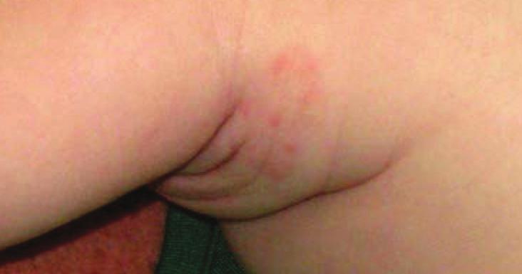 Most of these rashes are benign, and most are insect-related; but certain ones may be more ominous.