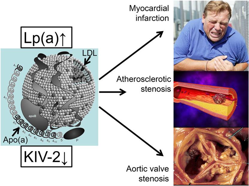 Although some cardiologists suspected for many years, as far back as the mid-1990s, that Lp(a) was a risk factor for aortic valve stenosis, a further novel development was the documentation by George