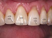 natural tooth color for beautiful aesthetic results. Direct anterior and posterior restorations, including sandwich technique with glass ionomer resin material. Core buildup. Splinting.