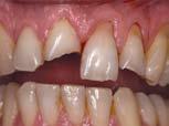 Easier to match the natural tooth color, in comparison to original Filtek Supreme XT Universal Restorative.