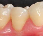 Primary teeth restorations. Transitional restorations. Small Class I restorations. Sandwich restorations. Class III and V restorations. Core buildups.