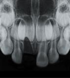 AVULSION OF A PRIMARY (B ABY) TOOTH? DO NOT REIMPLANT! Why? Potential trauma to the permanent tooth that is still developing.