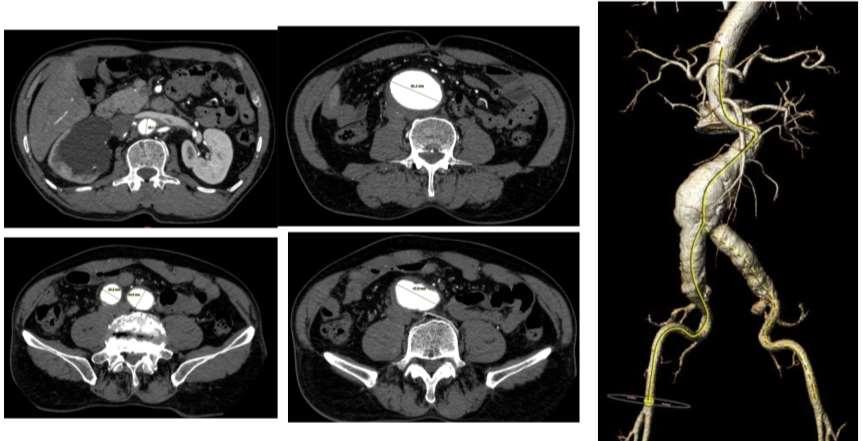 CASE PRESENTATION A 67-year-old man with a history of hypertension, hyperlipidemia and tobacco use was presented with right flank pain Computed tomography (CT) angiography revealed an AAA with