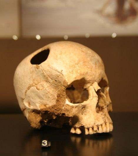 Skull Trepanation