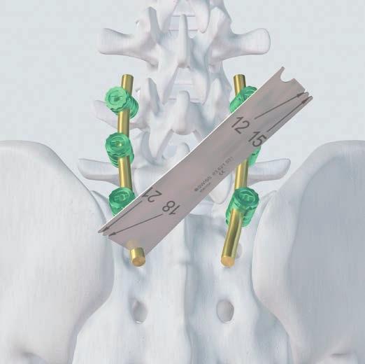 ILIAC FIXATION WITH ILIAC CONNECTOR 1 Instrument spine down to S1 Instrument the spine with a rod construct down to S1 according to the surgical technique of the implant system used (e.g. USS II Polyaxial).