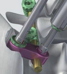 0 mm, with T-Handle 1 2 Pick up a nut using the Socket Wrench with Straight Handle (black), place it over the collet of the iliac screw and tighten it slightly.