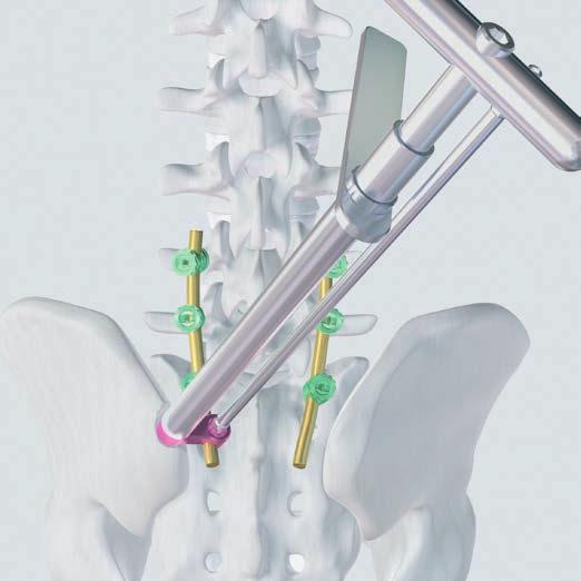 This is how the iliac connector is firmly attached to the bone screw while the polyaxiality is still maintained.