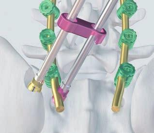 There are different connectors available for the linkage to the ilium and to the S2 pedicle.