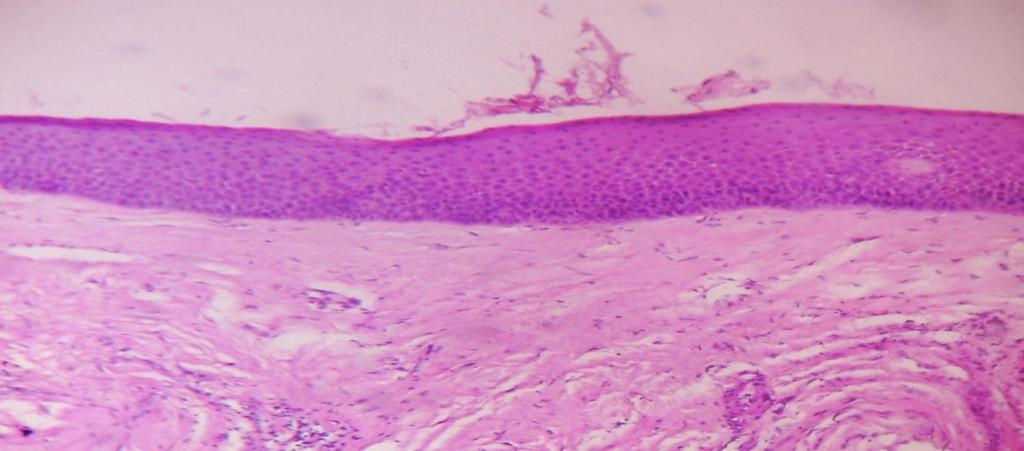 HISTOPATHOLOGY Photomicrograph shows an atrophic stratified squamous surface epithelium associated with a fibrous connective