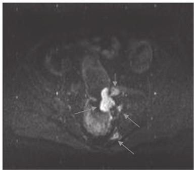 The observation of a small tumour (~1 cm), with pathological invasion to the shallow muscle layer resulted in the underestimation of one stage T2 case as stage T1. In stage T2, the sensitivity was 94.